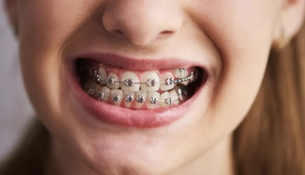 Aparat dentar inteligent: cum tehnologia revoluționează tratamentul ortodontic