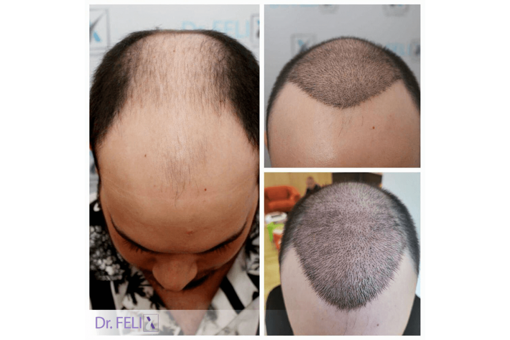 drfelix-hairimplant
